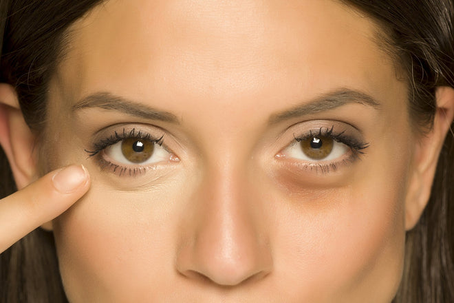 Eye Bags and Puffiness: Get Rid of Puffy Eyes